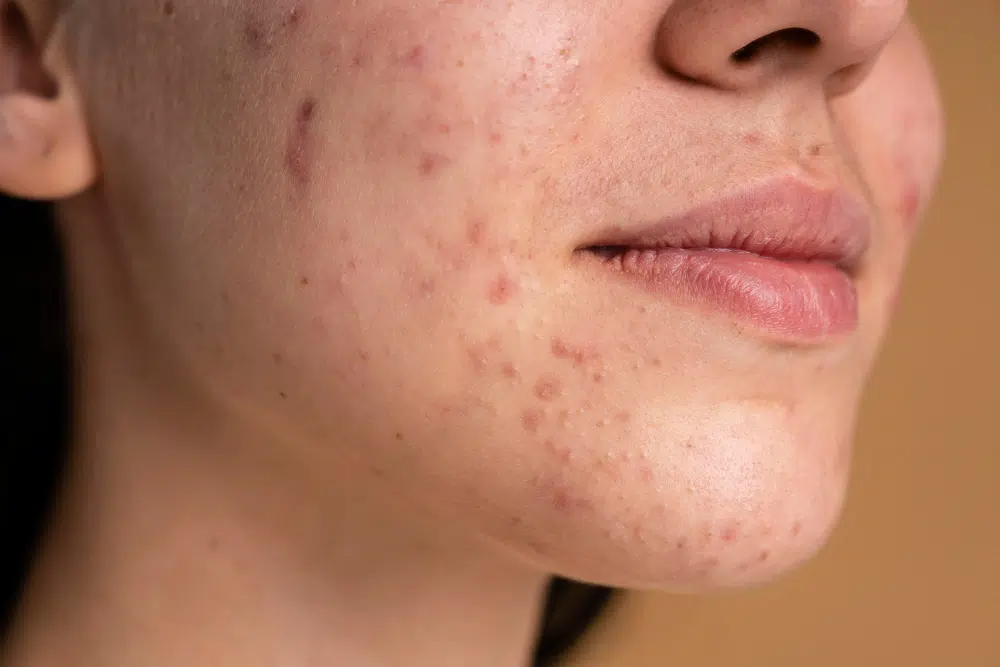 Hormonális aknétól és bőrproblémáktól szenvedőknek